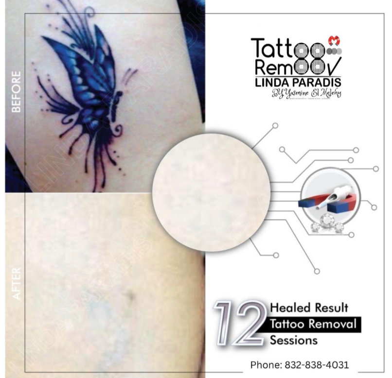 LINDA PARADIS OFFICIAL on Instagram Healed results  Before After Non  Invasive Magnetic tattoo removal Technique magnetictattooremoval  lindaparadis tattooremovalinc